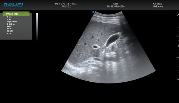 DW-T8 ultrasound machine image abdomen 2