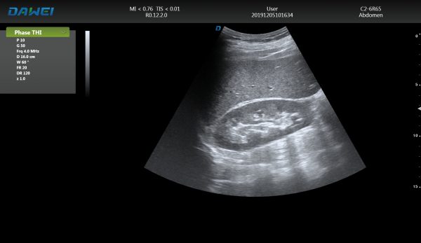 DW-T8 ultrasound machine image abdomen 3