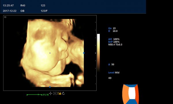 DW-T6 ultrasound machine image GYN 4D 3